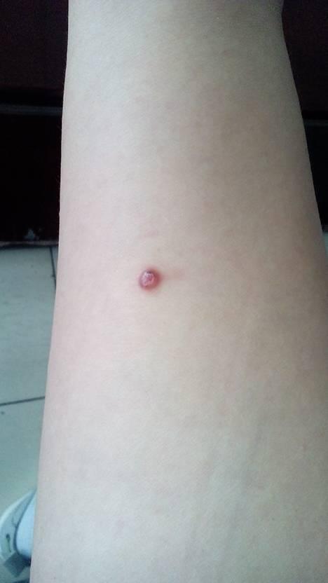 问:胳膊上红疙瘩,不痛不痒,怕有别的病症,有懂得给看看吧,谢谢!