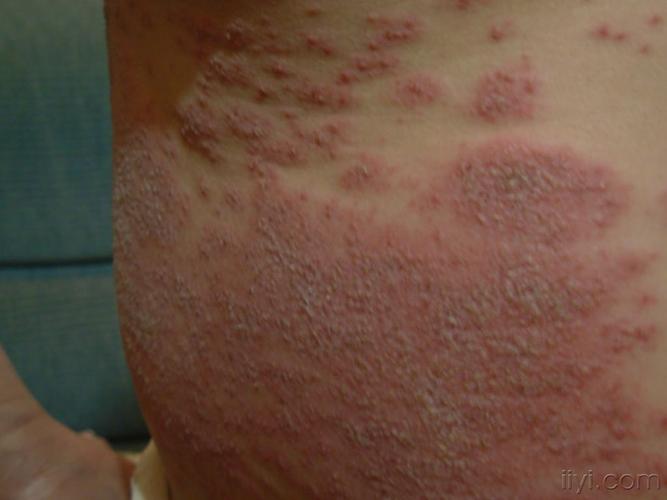 泛发性湿疹