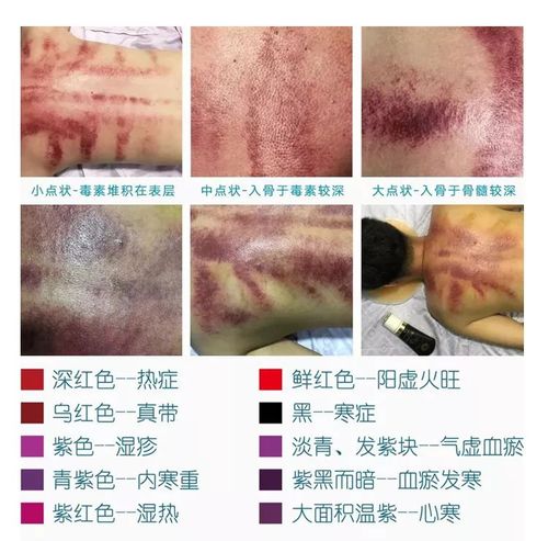 看看刮完后的颜色,兄dei,你该养生了~ 当然,自己也能刮哦,只要有时间