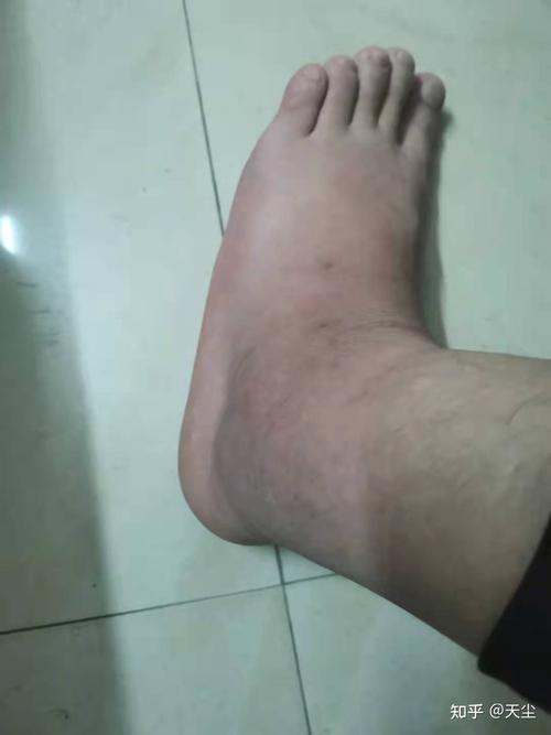 我上次痛风发作是半年前,今年一月份,脚踝肿得像猪蹄一样.