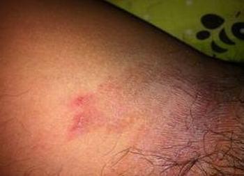 尖锐湿疣的普遍症状是什么