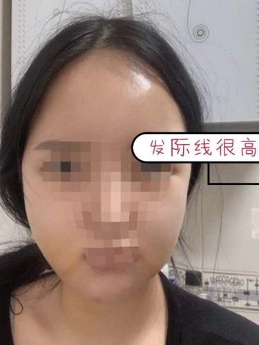 别人都说额头大好看,聪明,但我额头也太大了吧,也没见很聪明啊,显得发