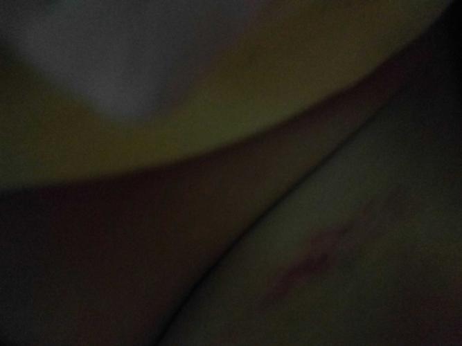 宝宝大腿被尿不湿割破流血,贝贝网说