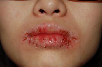 揪出导致嘴唇干裂的8大罪魁祸首