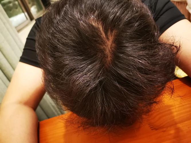 请问,头顶这个发量有问题吗