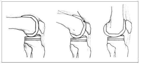 膝关节弯曲时出现"摩擦音"或"弹响"是什么原因?