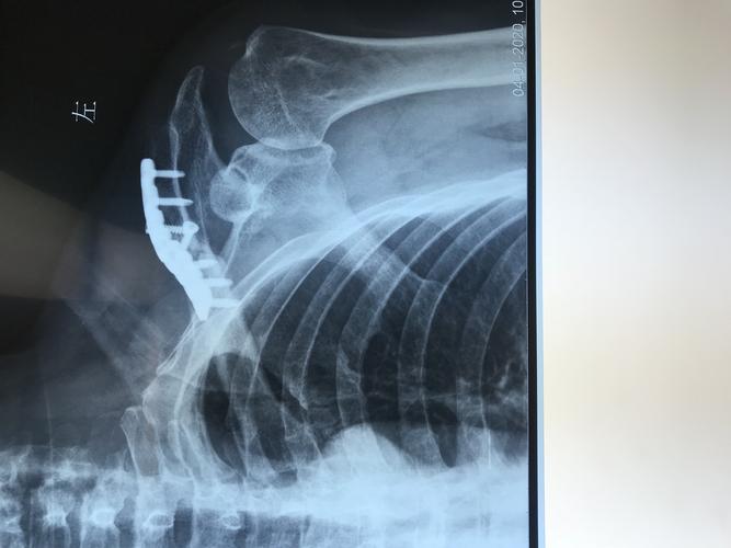 锁骨骨髓炎,外架