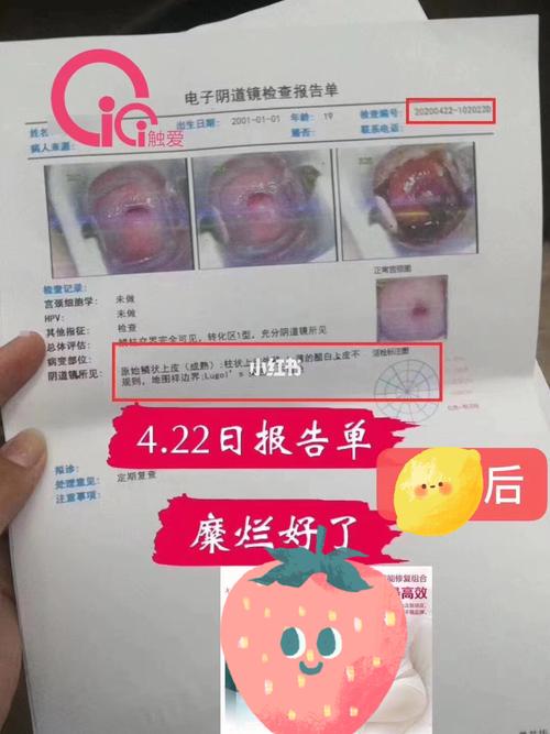 表妹宫颈糜烂二度,一个月就调理好了_宫颈糜烂_凝胶_保养_医疗健康