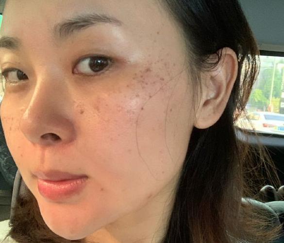 告诉小华她脸上的斑点是黄褐斑,正常来说黄褐斑一般是40-50岁的女人