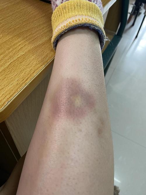 我的腿常年带淤青,怎么救?