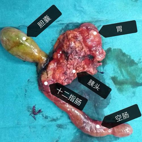 普外科年终力作——胰十二指肠切除术