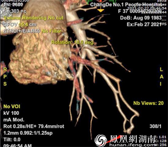 ge256排超高端revolutionct血管成像检查生成vr图像,提示左下肺动脉与