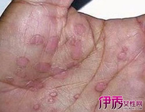 图梅毒初期症状图大全介绍5种病情特征让你了解更多