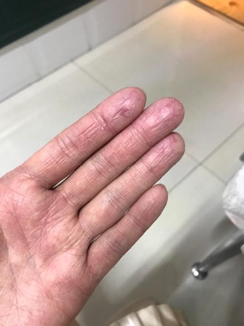 手心季节性的剥皮,角质层都没有了,特别疼,抹了很多药物也不好使,请问