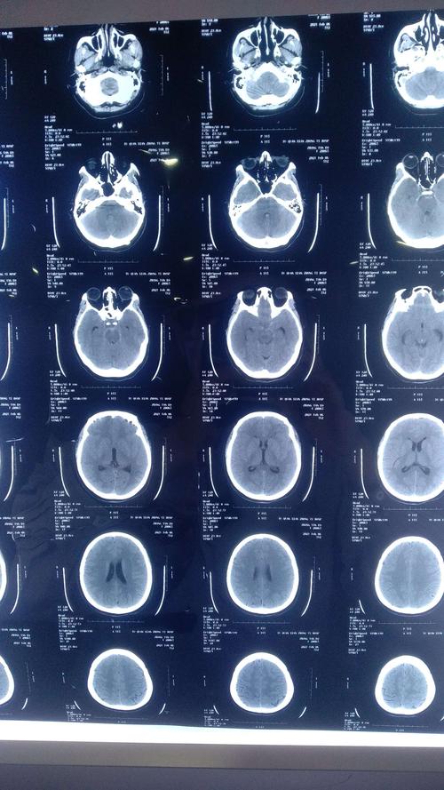 头部ct提示蛛网膜下腔出血