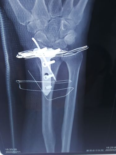 桡骨远端粉碎骨折 波及关节面