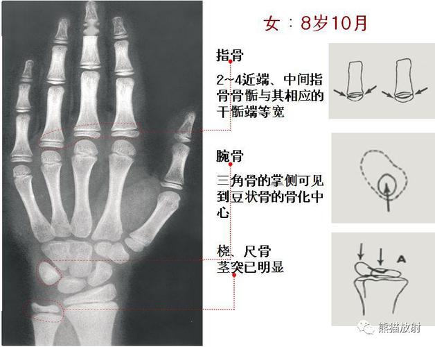 收藏丨骨龄图谱方便随时对照