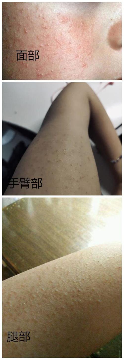 常染色体显性遗传所导致的,毛囊口的角质代谢异常,过度角化