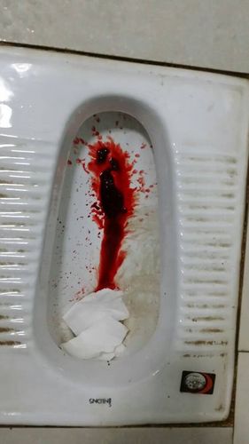 我大便有鲜血出现不知什么病情