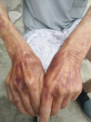 问:家里老人碰到哪里,哪里就出现血块.