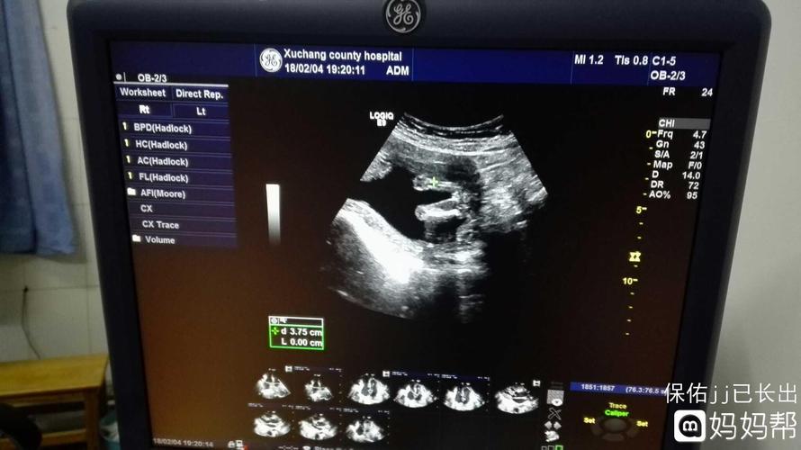 今天的彩超女宝图最后一张是三条线的