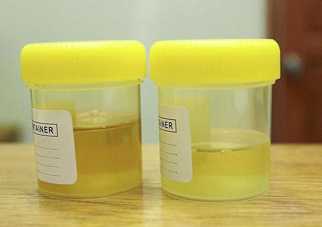 很多人分不清自己的尿液:蛋白尿,泡沫尿,正常尿三者的