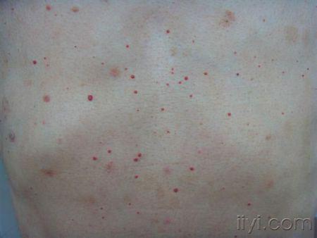 手臂上有很多小红点,是不是毛细血管爆裂啊,有什么办法避免啊?