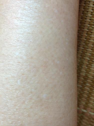 问:脚上这个白白的点点有两三年了越长越多 怎么回事