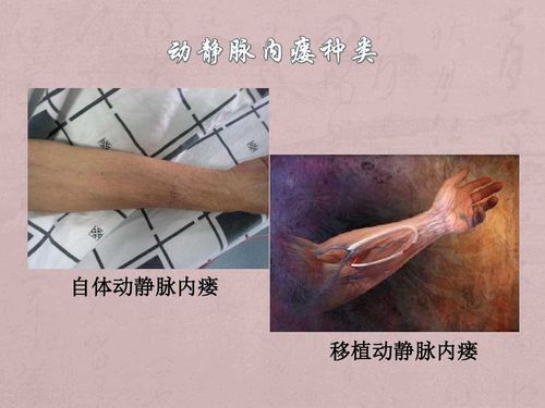 维护动静脉内瘘的五个"好"