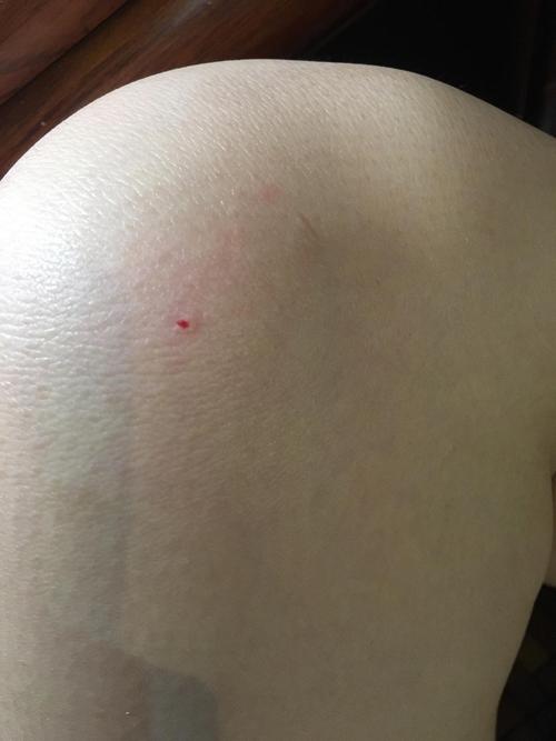 如图,被小猫爪子勾了一下,渗了一点点血,家里养的猫,刚打了猫三联的第