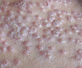 湿疹的严重症状有哪些