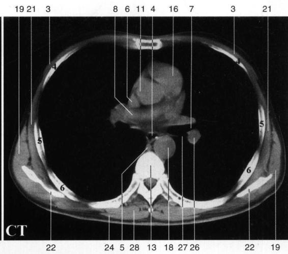 竖脊肌 erector spinae s Ⅲ