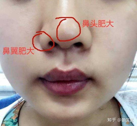 一,鼻头肥大的原因大致可分为先天发育性和手术以后造成的鼻头大两类