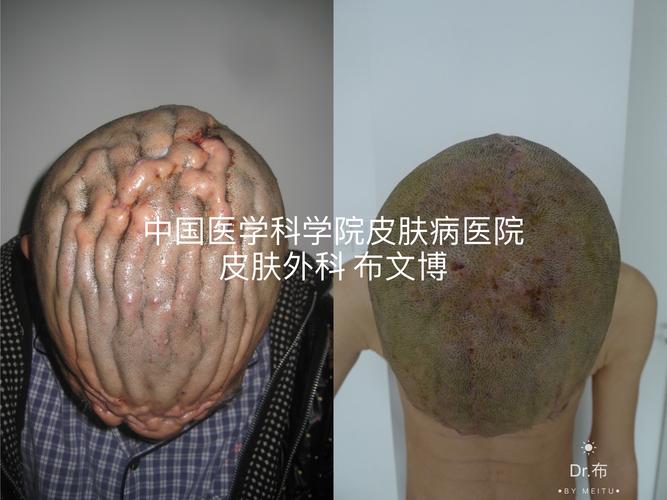 化脓性汗腺炎可以治疗,可以治愈