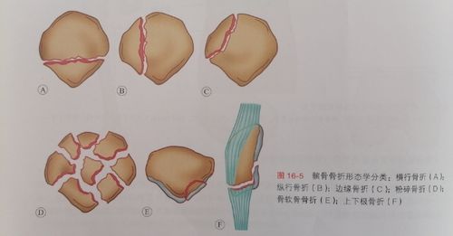 间接暴力,膝半屈位股四头肌强力牵拉所致,骨折多为横行,或下极碎裂.