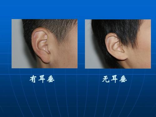 有耳垂 无耳垂