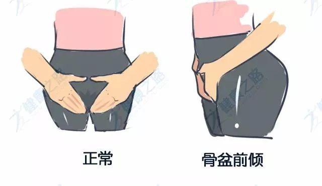 知识君你以为的翘臀90是骨盆前倾男女都有危害还不小