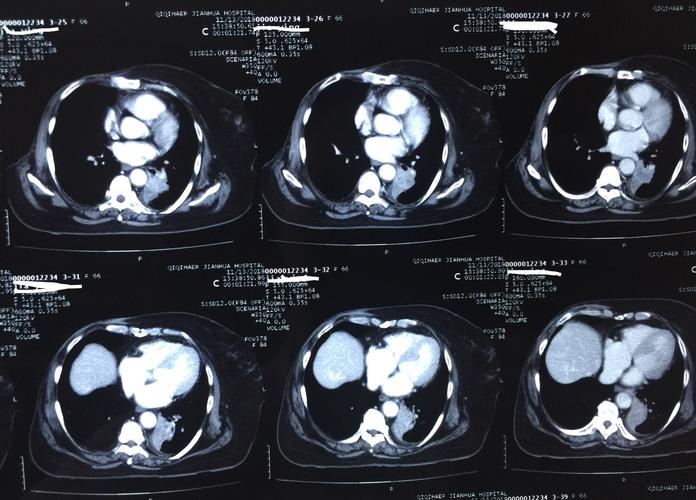 术前肺部增强ct片