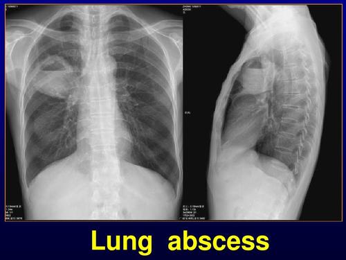 lung abscess