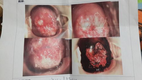 请帮我看看阴道镜检查,宫颈糜烂严不严重.