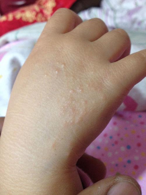 我的孩子4周岁手上起了些小疙瘩,手心手背很痒.孩子老