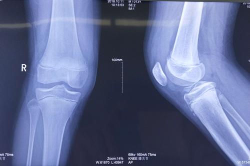 胫骨髁间棘骨折