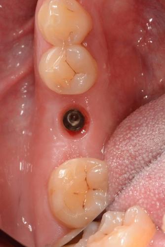 精贝口腔种植牙病例