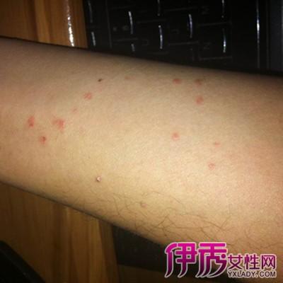 梅毒的症状_梅毒的早期症状