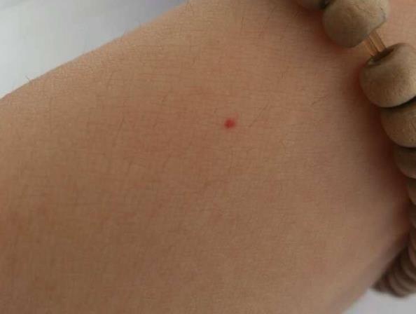 身上突然长出一些小红痣正常吗可能预示着某些疾病