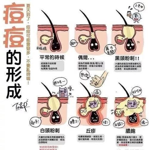 你是痘痘肌吗?趣痘驿站提醒你两大原因不容忽视