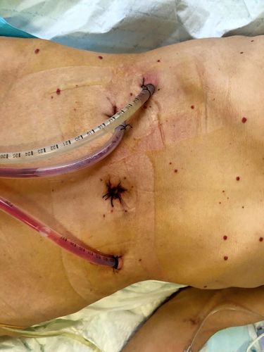 普外科微创治疗胃穿孔(胃后壁穿孔)