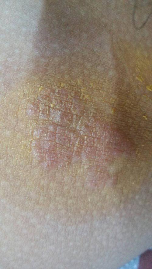 可能是阴囊湿疹