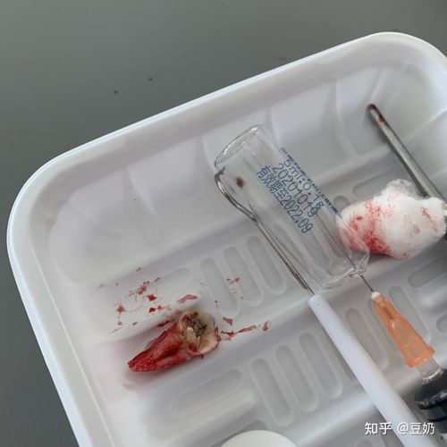 当我的智齿蛀牙后我.