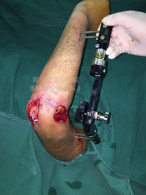 肘关节开放性粉碎性骨折术后软组织缺损骨外露